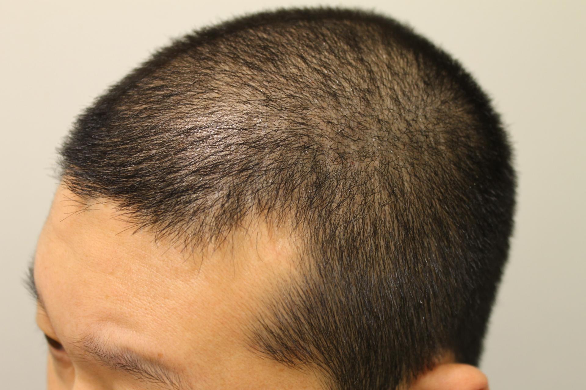 プロペシアとミノキシジルタブレットの効果 ４ヵ月間 実際の写真あり プロペシアとミノキシジルタブレットの効果 を30代の薄毛中年が実際に服用する育毛実践記ブログ 育毛の効果はあるのか 副作用はあるのか
